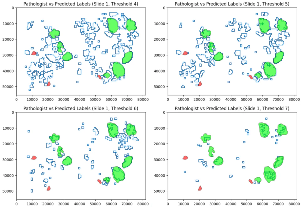 Four panels compare model-predicted tumor outlines in blue with a pathologist's tumor annotations in green and other cell-type annotations in red on the same biopsy slide, at threshold settings 4, 5, 6 and 7.