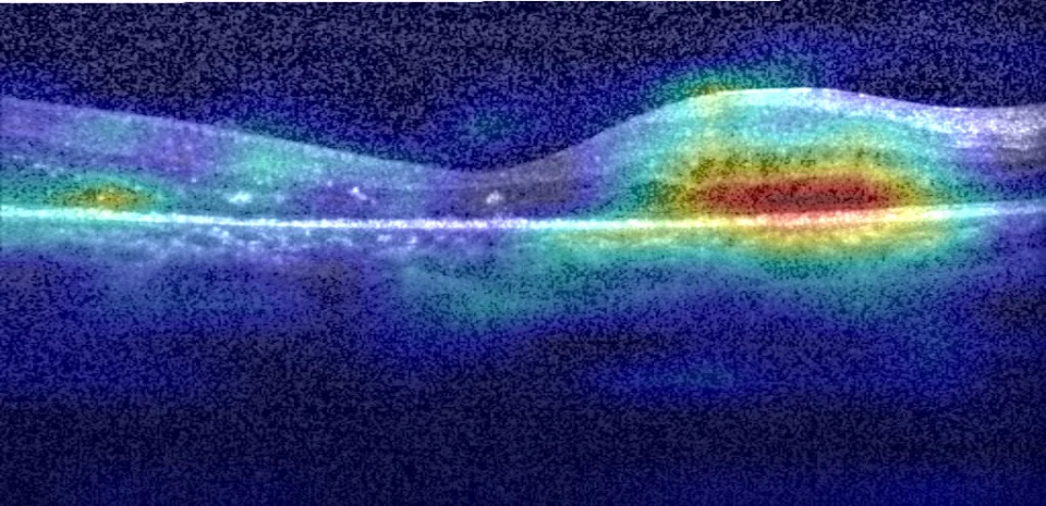 A retinal OCT scan with a Grad-CAM heatmap highlighting part of the retinal structure.
